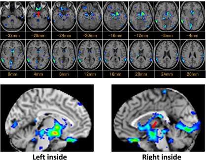 Brain MRI findings analyzed by VSRAD in patients with long COVID