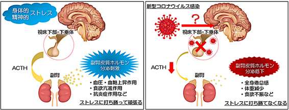 視床下部性副腎不全のメカニズム（通常時と新型コロナウイルス感染時の比較）