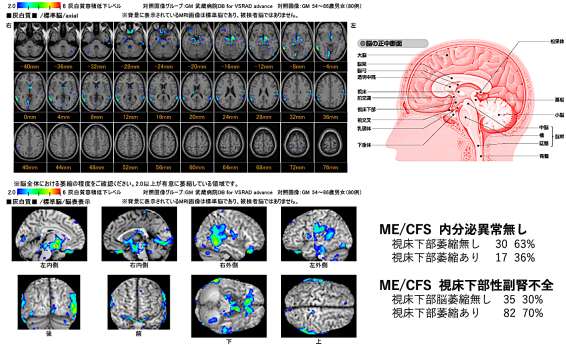 脳MRI VSRAD解析結果
